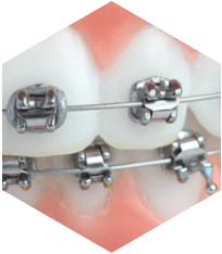 Teeth Alignment