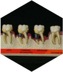 Gum treatment 