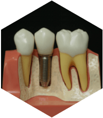 Implants