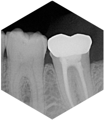 Root Canal 